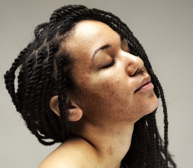 Jerawat tidak mendefinisikan dirimu/Foto: https://insider.com skin positivity