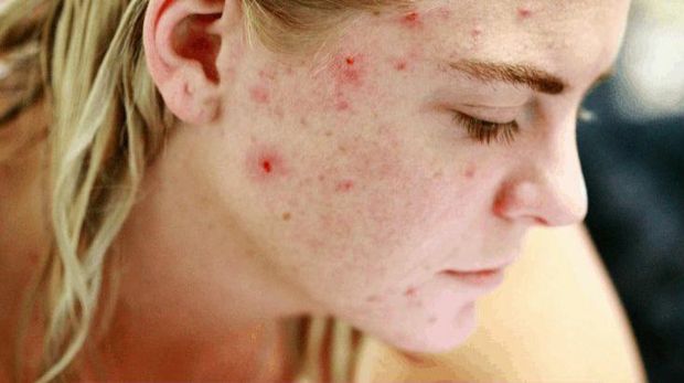 Jerawat dewasa biasa menyerang wanita berusia 26 tahun ke atas/Foto: Pinterest/GirlUnfinished