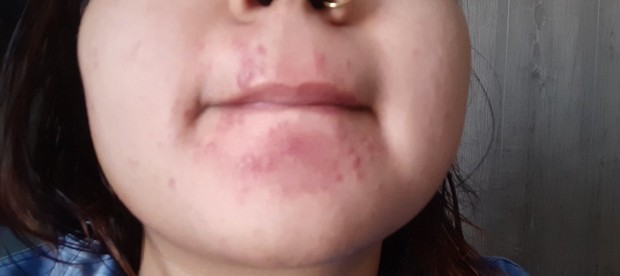 dermatitis perioral/sumber:twitter.com/gresaids/ dermatitis perioral