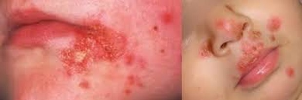 impetigo krustosa/sumber:forum.detik.com impetigo krustosa