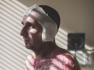 Pria Ini Kesetrum, Kulitnya Meleleh Sampai Kelihatan Tulangnya