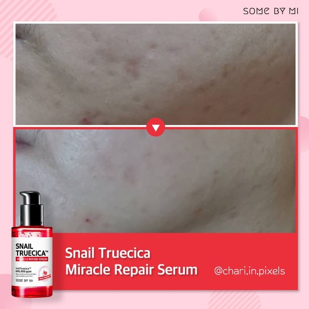 klaim nya mampu menghilangkan bekas jerawat dan meratakan kulit.