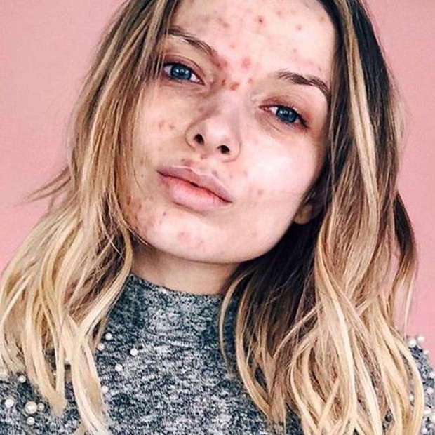 n Permasalahan Kulit yang Sering Keliru Dianggap Jerawat Biasa