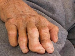 RI Ranking ke-3 Kasus Kusta Tertinggi Dunia, Penyakit yang Kerap Dianggap Kutukan