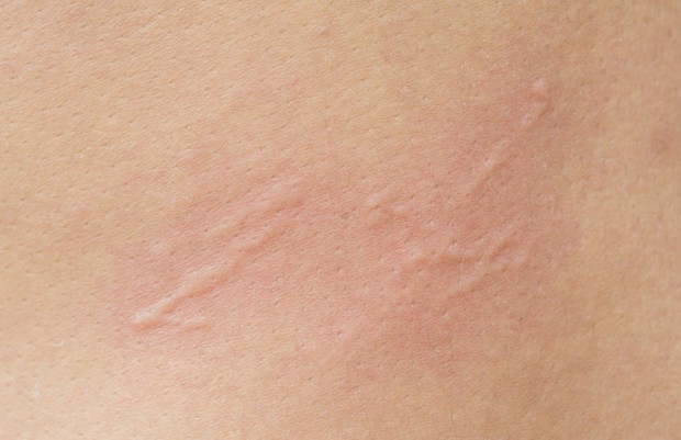 Rasa gatal/foto: freepik.com Rasa gatal