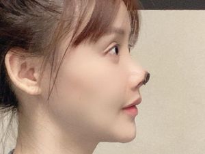 Gegara Oplas Gagal, Hidung Aktris China Ini Menghitam dan Membusuk Gegara Oplas Gagal, Hidung Aktris China Ini Menghitam dan Membusuk
