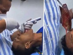 Duh! Ikan Sepanjang 43 Cm Nyangkut di Tenggorokan Pria Ini