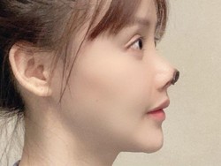 Cerita Aktris China yang Ujung Hidungnya Menghitam Usai Bedah Kosmetik