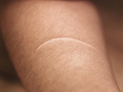 Codet hingga Pitak, Ini 7 Istilah Bekas Luka dalam KBBI