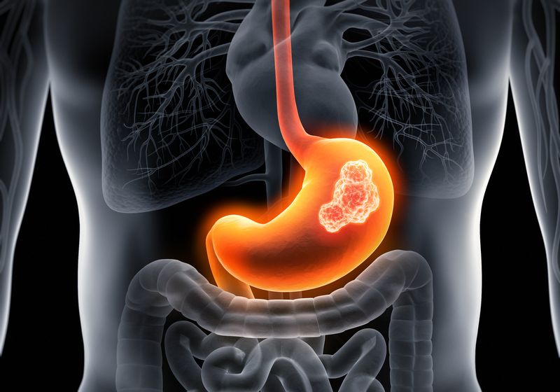 Medical x-ray  illustration of stomach cancer - stomach tumor