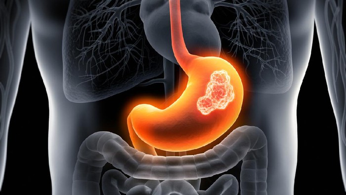 Medical x-ray  illustration of stomach cancer - stomach tumor