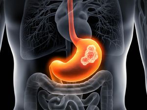 Wanita Idap Kanker Lambung Stadium 4, Gejalanya Sering Dikira GERD oleh Dokter Wanita Idap Kanker Lambung Stadium 4, Gejalanya Sering Dikira GERD oleh Dokter
