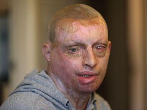 Kisah Pria yang Disiram Air Keras oleh Mantan Kekasih, Begini Keadaannya Kini