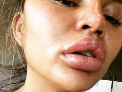 Ngeri, Bibir Chrissy Teigen Bengkak Setelah Gigit Kulit Jeruk