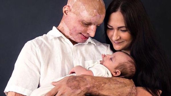 Potret Pria Berwajah Rusak karena Disiram Air Keras Oleh Mantan Kekasihnya