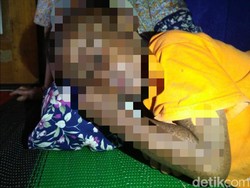 Idap Penyakit Langka, Bocah Sukabumi Dilarang Terpapar Sinar Matahari