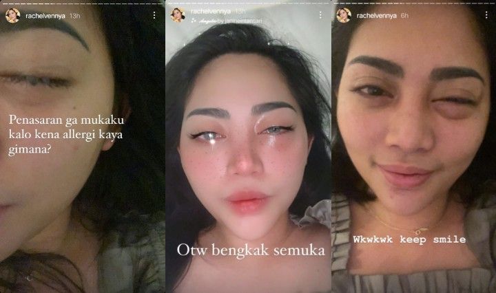 Wajah Rachel Vennya Bengkak