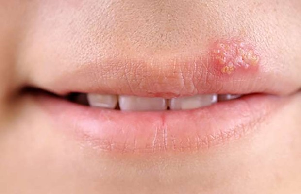 Hindari yang memicu cold sores/winningsmilespd.com Cold sores adalah gejala dari kondisi virus yang disebut herpes, kadang-kadang ini disebut lepuh dalam atau herpes mulut merupakan hal yang sangat umum terjadi.
