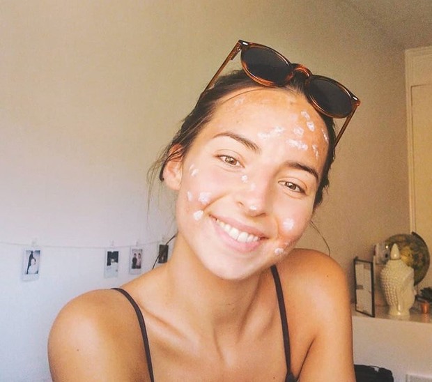 Acne Patch vs Totol Jerawat, Mana yang Lebih Ampuh Atasi Jerawat?