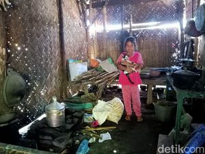 Nafisa, Bocah yang Ingin Operasi Luka Bakar Agar Tak Terus Diejek Teman