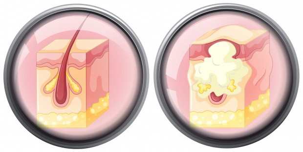 Kenali Jenis Jerawatmu dan Cara Mengatasinya/freepik.com Kenali Jenis Jerawatmu dan Cara Mengatasinya/freepik.com