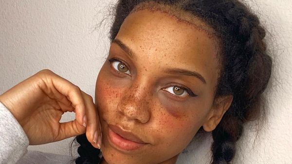 8 Foto Wanita yang Jadi Viral karena Operasi Mengecilkan Jidat Jenong