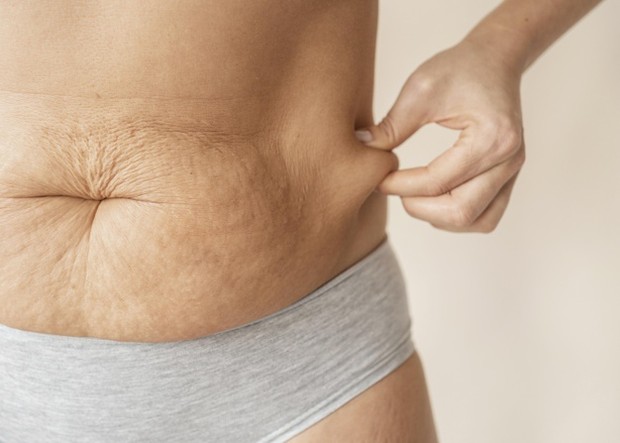 Ilustrasi perut setelah melahirkan. (Freepik) Ilustrasi perut setelah melahirkan.