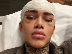 Pria Oplas agar Cantik Seperti Filter IG, Malah Dihujat Mirip Squidward