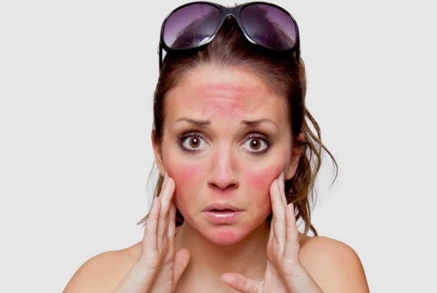 Sunburn/beautyhealthtips.in