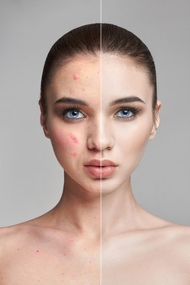 Makeup Saat Berjerawat/ Sumber: Freepik.com Kamu juga dapat mencoba krim benzoil peroksida berwarna yang menyembunyikan jerawat sekaligus membantu mengobatinya.