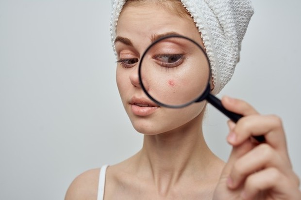 Mengatasi Jerawat/ Sumber: Freepik.com Ketahui bahwa obat jerawat mengandung bahan pengering seperti benzoyl peroxide dan asam salisilat.