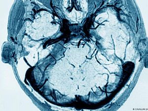 Vaksin AstraZeneca, Apa Masalah Sebetulnya dengan Trombosis?