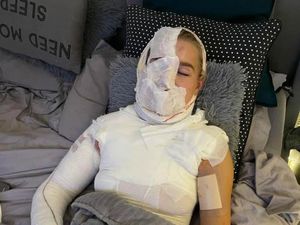 Wajah Selebgram Kena Bola Api Saat Bikin Tutorial Online, Begini Kondisinya