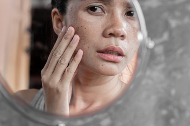 Kulit jadi kemerahan saat terkena sinar matahari/freepik.com