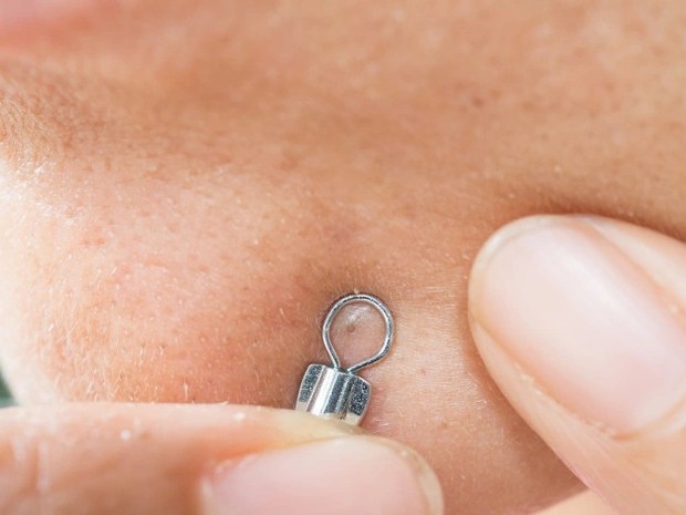 Cara mengatasi komedo bisa dengan bantuan alat khusus ataupun kandungan bahan tertentu/freepik.com