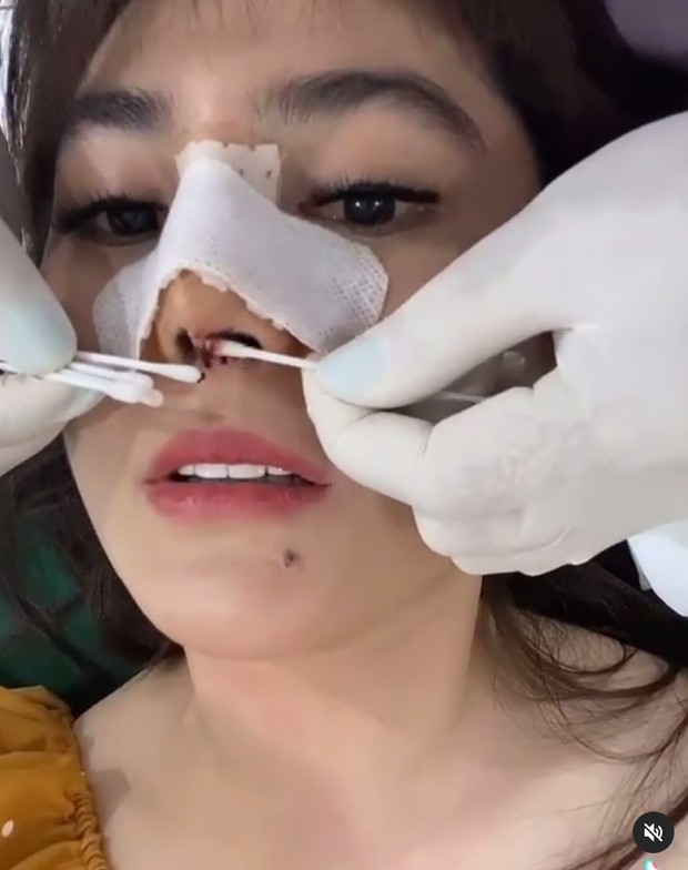 Angela Lee melakukan operasi plastik pada hidungnya