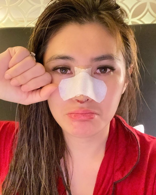 Angela Lee melakukan operasi plastik pada hidungnya