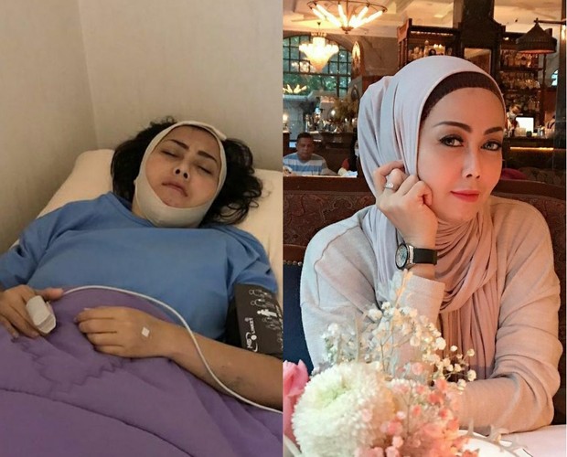 Rency Milano jadi korban filler dagu/Foto: Instagram.com/elmatheana/rency_milano malpraktek klinik kecantikan