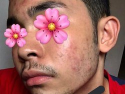 Viral Transformasi Pria Jerawatan Jadi Glow Up Berkat Produk Gratis