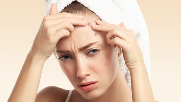 Ilustrasi kulit berjerawat.