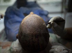 Wisata Medis ke Turki Ternyata Simpan Masalah