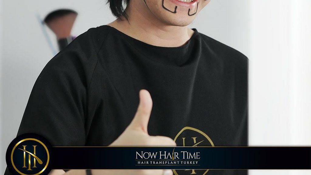 7 Foto Kevin Aprilio Cangkok Rambut di Turki, Sempat Tampil Botak 7 Foto Kevin Aprilio Cangkok Rambut di Turki, Sempat Tampil Botak