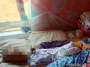 Kisah Pilu Bocah 9 Tahun Pengidap Hidrosefalus di Banjarnegara