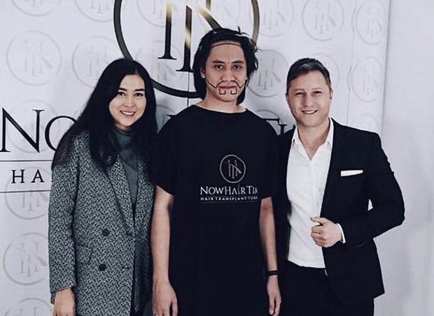 Mengenal Cangkok Rambut yang Dilakukan Kevin Aprilio