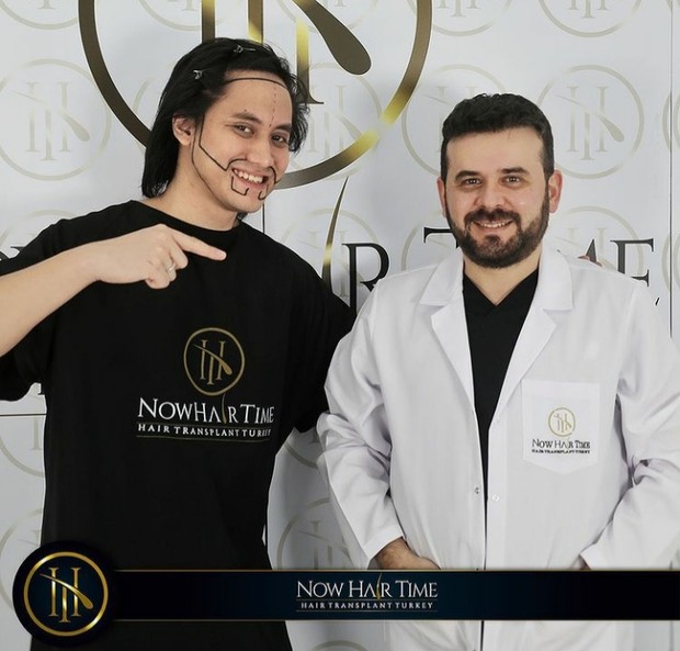 Cangkok Rambut yang Dilakukan Kevin Aprilio