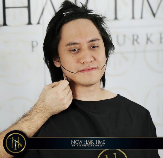 Cangkok Rambut yang Dilakukan Kevin Aprilio