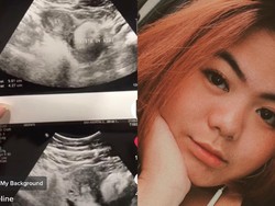 Viral Kisah Wanita Haid Tidak Teratur, Pilih USG Sendirian, Ternyata...