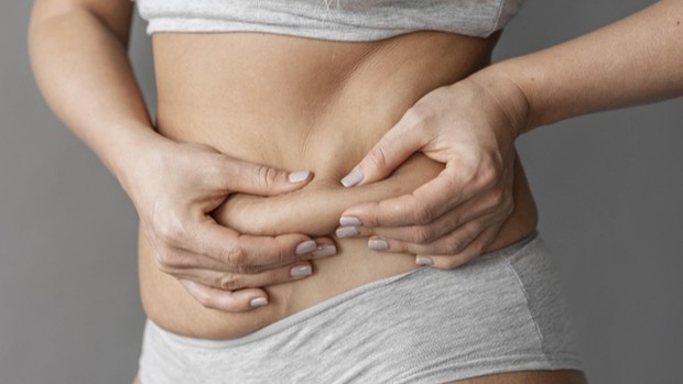 Ilustrasi stretch mark.