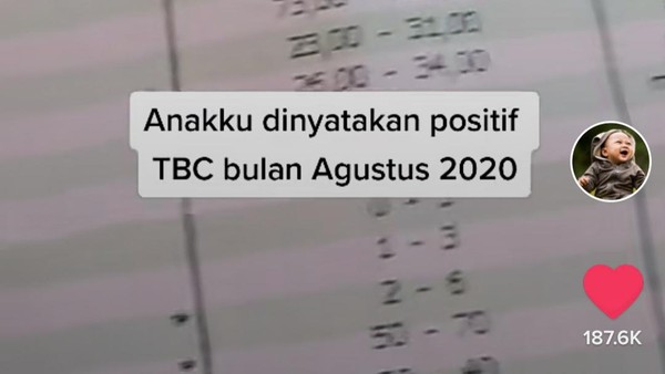Viral cerita anak kena TBC diduga karena dicium orang lain.