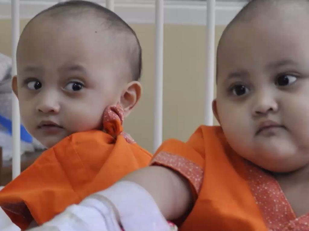 RSAB Harapan Kita Pisahkan Kembar Siam Dempet Tulang Ekor Naifa-Nayyara